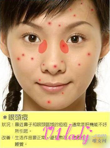 根据痘痘长的位置来判断自己身体各个部位的健康情况