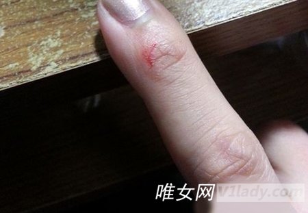 小伤口怎么处理？湿润敷料加速伤口愈合