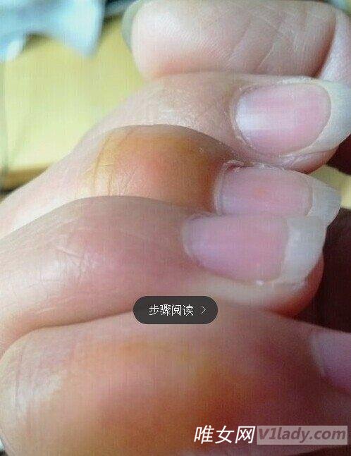 冬天怎么样才不会长冻疮？